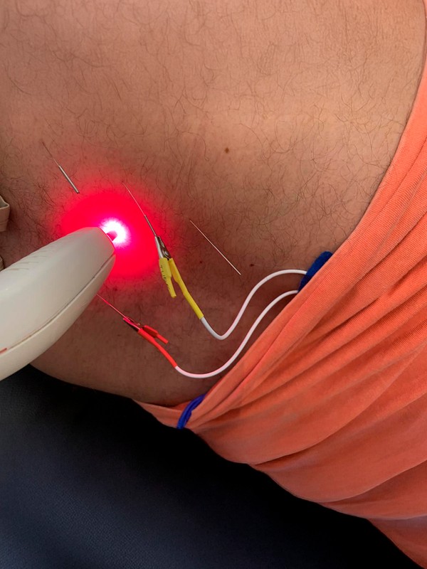 Técnica de Agulhamento com Laser